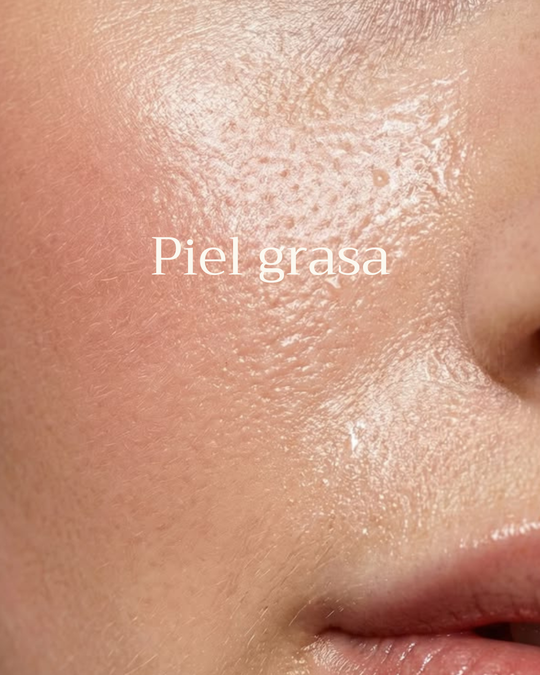 Piel Grasa